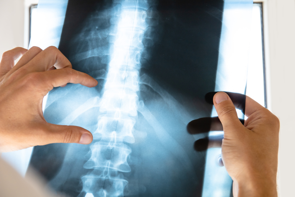 Average Compensation For Fractured Sternum Pasadena thumbnail