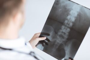 Spinal Cord Injury